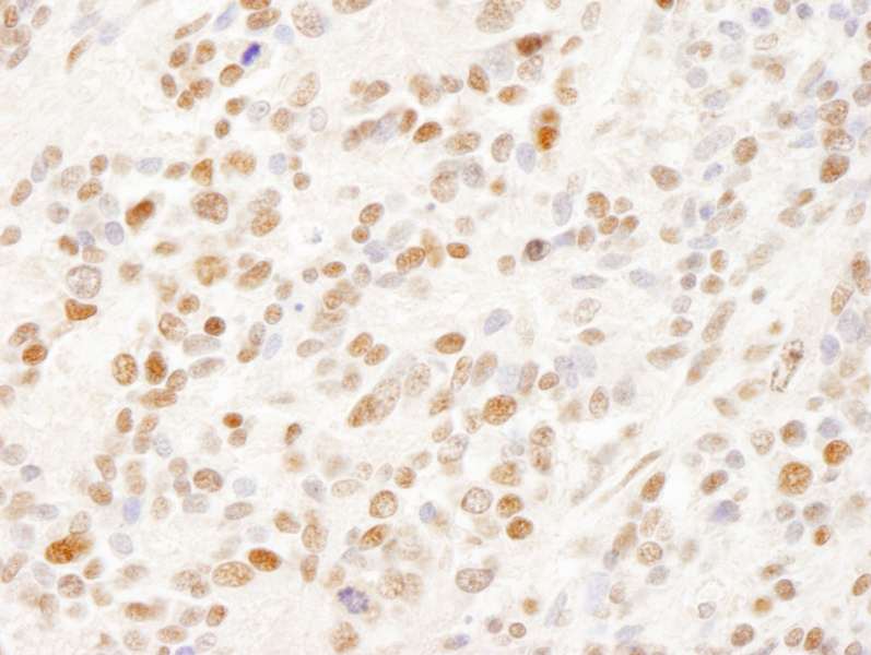 Detection of Human SFRS14 by Immunohistochemistry. Sample: FFPE section of human Ewing sarcoma. Antibody: Affinity purified rabbit anti-SFRS14 used at a dilution of 1:200 (1 ug/ml). Detection: DAB.