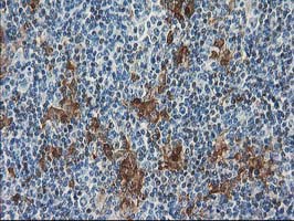 IHC of paraffin-embedded Human lymphoma tissue using anti-SULT1C2 mouse monoclonal antibody. (Heat-induced epitope retrieval by 10mM citric buffer, pH6.0, 100C for 10min).