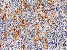 IHC of paraffin-embedded Human lymphoma tissue using anti-SULT1C2 mouse monoclonal antibody.