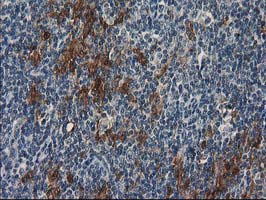 IHC of paraffin-embedded Human lymphoma tissue using anti-SULT1C2 mouse monoclonal antibody.