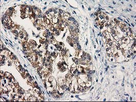 IHC of paraffin-embedded Adenocarcinoma of Human ovary tissue using anti-SULT1C2 mouse monoclonal antibody.