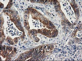 IHC of paraffin-embedded Adenocarcinoma of Human colon tissue using anti-SULT1C2 mouse monoclonal antibody.