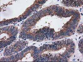 IHC of paraffin-embedded Adenocarcinoma of Human endometrium tissue using anti-SULT1C2 mouse monoclonal antibody. (Heat-induced epitope retrieval by 10mM citric buffer, pH6.0, 100C for 10min).