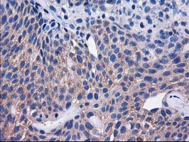 IHC of paraffin-embedded Carcinoma of Human bladder tissue using anti-SULT1C2 mouse monoclonal antibody. (Heat-induced epitope retrieval by 10mM citric buffer, pH6.0, 100C for 10min).
