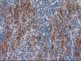 IHC of paraffin-embedded Human lymphoma tissue using anti-SULT1C2 mouse monoclonal antibody. (Heat-induced epitope retrieval by 10mM citric buffer, pH6.0, 100C for 10min).