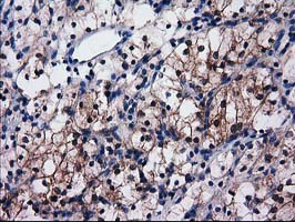 IHC of paraffin-embedded Carcinoma of Human kidney tissue using anti-SULT1C2 mouse monoclonal antibody. (Heat-induced epitope retrieval by 10mM citric buffer, pH6.0, 100C for 10min).