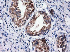 IHC of paraffin-embedded Adenocarcinoma of Human ovary tissue using anti-SULT1C2 mouse monoclonal antibody. (Heat-induced epitope retrieval by 10mM citric buffer, pH6.0, 100C for 10min).