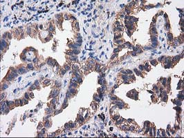 IHC of paraffin-embedded Carcinoma of Human lung tissue using anti-SULT1C2 mouse monoclonal antibody. (Heat-induced epitope retrieval by 10mM citric buffer, pH6.0, 100C for 10min).