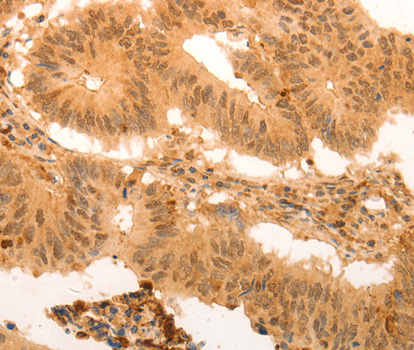 Immunohistochemistry of paraffin-embedded Human colon cancer tissue using SUMO4 Antibody at dilution 1/100.