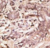 Formalin-fixed and paraffin-embedded human cancer tissue reacted with the primary antibody, which was peroxidase-conjugated to the secondary antibody, followed by AEC staining. This data demonstrates the use of this antibody for immunohistochemistry; clinical relevance has not been evaluated. BC = breast carcinoma; HC = hepatocarcinoma.