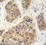 Formalin-fixed and paraffin-embedded human hepatocarcinoma tissue reacted with SUMO4 antibody (M55 Wild type) , which was peroxidase-conjugated to the secondary antibody, followed by DAB staining. This data demonstrates the use of this antibody for immunohistochemistry; clinical relevance has not been evaluated.