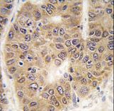 Formalin-fixed and paraffin-embedded human hepatocarcinoma tissue reacted with SUMO4 antibody (V55 Mutant) , which was peroxidase-conjugated to the secondary antibody, followed by DAB staining. This data demonstrates the use of this antibody for immunohistochemistry; clinical relevance has not been evaluated.