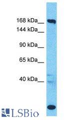 SUPT6H / SPT6 antibody Western Blot of Colorectal Tumor. Antibody dilution: 1 ug/ml.