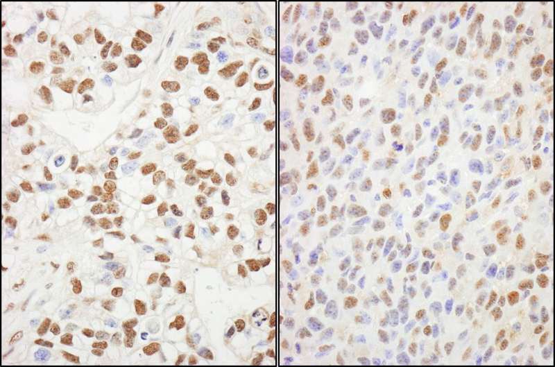Detection of Human and Mouse SUPT6H by Immunohistochemistry. Sample: FFPE sections of human breast carcinoma (left) and mouse squamous cell carcinoma (right). Antibody: Affinity purified rabbit anti-SUPT6H used at a dilution of 1:200 (1 ug/ml). Detection: DAB.