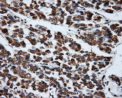 IHC of paraffin-embedded Carcinoma of liver tissue using anti-PTPRE mouse monoclonal antibody. (Dilution 1:50).