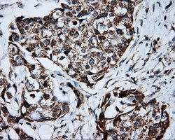 IHC of paraffin-embedded Adenocarcinoma of breast tissue using anti-PTPRE mouse monoclonal antibody. (Dilution 1:50).