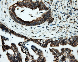 IHC of paraffin-embedded Adenocarcinoma of colon tissue using anti-PTPRE mouse monoclonal antibody. (Dilution 1:50).