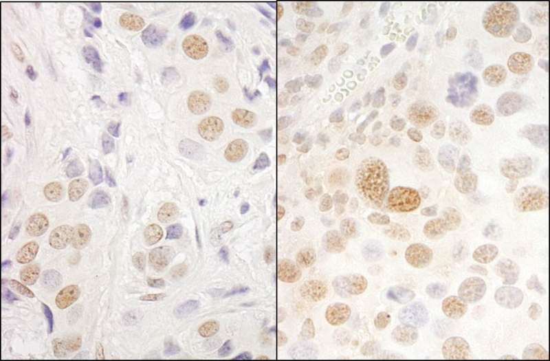 Detection of Human and Mouse hPrp3p by Immunohistochemistry. Sample: FFPE section of human breast carcinoma (left) and mouse renal cell carcinoma (right). Antibody: Affinity purified rabbit anti-hPrp3p used at a dilution of 1:5000 (0.2and 1:1000 (1 Detection: DAB.