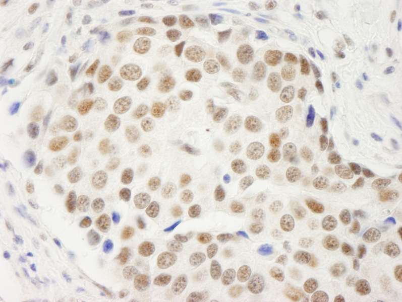 Detection of Human Symplekin by Immunohistochemistry. Sample: FFPE section of human breast carcinoma. Antibody: Affinity purified rabbit anti-Symplekin used at a dilution of 1:200 (1 ug/ml). Detection: DAB.