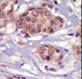 Formalin-fixed and paraffin-embedded human cancer tissue reacted with the primary antibody, which was peroxidase-conjugated to the secondary antibody, followed by DAB staining. This data demonstrates the use of this antibody for immunohistochemistry; clinical relevance has not been evaluated. BC = breast carcinoma; HC = hepatocarcinoma.