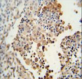CADM1 antibody immunohistochemistry of formalin-fixed and paraffin-embedded human lung carcinoma followed by peroxidase-conjugated secondary antibody and DAB staining.