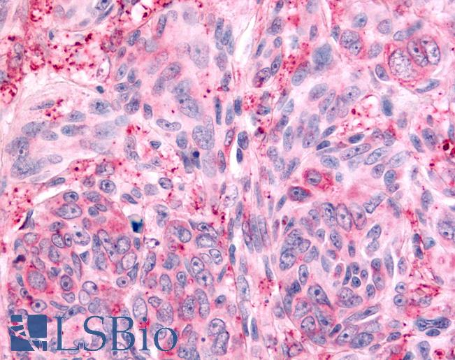 Anti-PTPRE / PTP Epsilon antibody IHC of human Skin, Melanoma. Immunohistochemistry of formalin-fixed, paraffin-embedded tissue after heat-induced antigen retrieval.