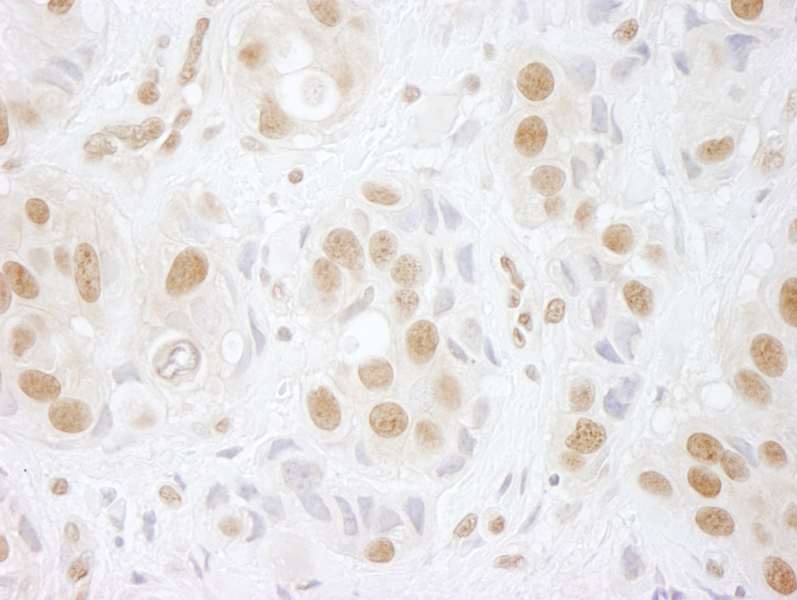 Detection of Human hPrp3p Immunohistochemistry. Sample: FFPE section of human breast carcinoma. Antibody: Affinity purified rabbit anti-hPrp3p used at a dilution of 1:100.