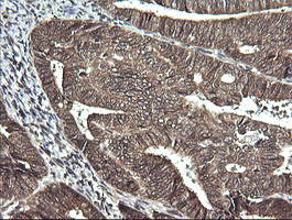 IHC of paraffin-embedded Adenocarcinoma of Human endometrium tissue using anti-SYT4 mouse monoclonal antibody. (Heat-induced epitope retrieval by 10mM citric buffer, pH6.0, 120°C for 3min).
