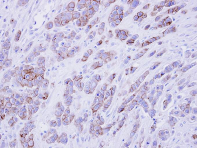 IHC of paraffin-embedded MDAMB468 xenograft using phospholipid scramblase 1 antibody at 1:500 dilution.