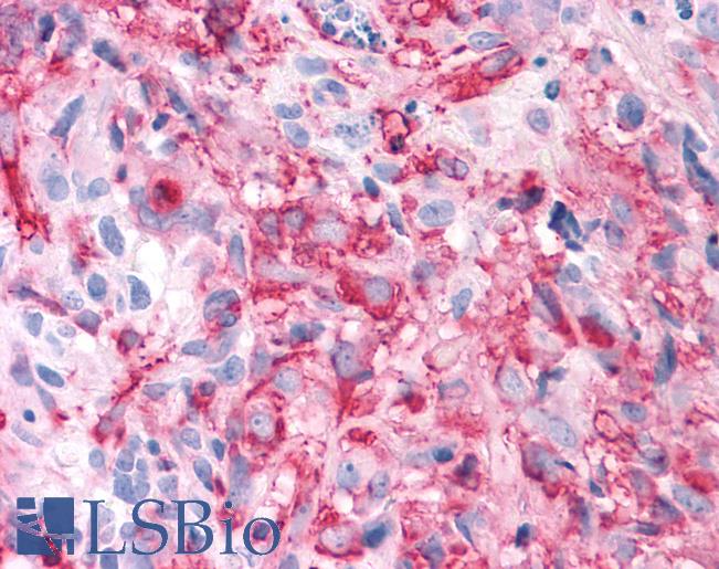 Anti-T1R3 / TAS1R3 antibody IHC of human Brain, Glioblastoma. Immunohistochemistry of formalin-fixed, paraffin-embedded tissue after heat-induced antigen retrieval.