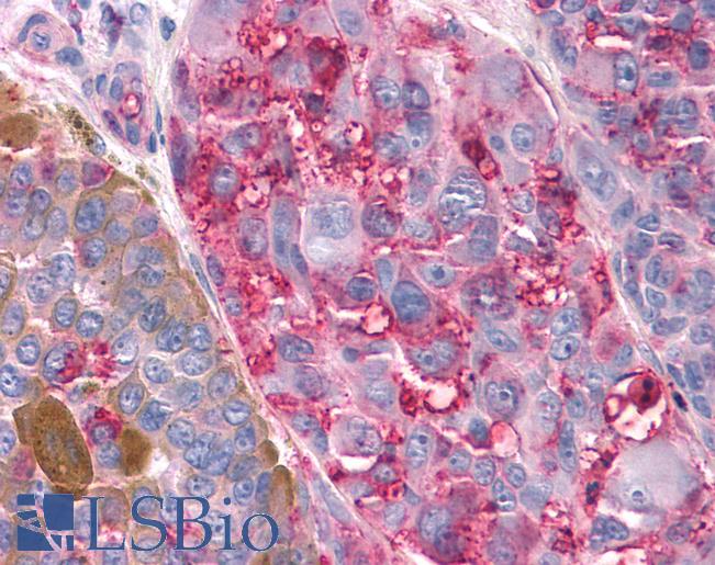 Anti-T1R3 / TAS1R3 antibody IHC of human Skin, Melanoma. Immunohistochemistry of formalin-fixed, paraffin-embedded tissue after heat-induced antigen retrieval.