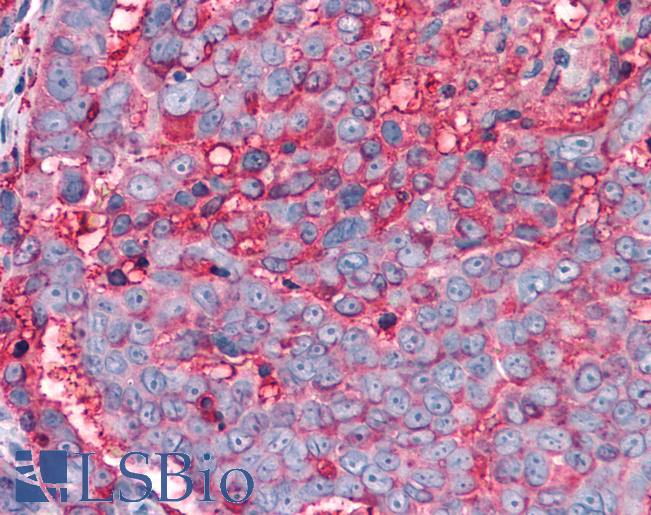 Anti-T1R3 / TAS1R3 antibody IHC of human Ovary, Carcinoma. Immunohistochemistry of formalin-fixed, paraffin-embedded tissue after heat-induced antigen retrieval.