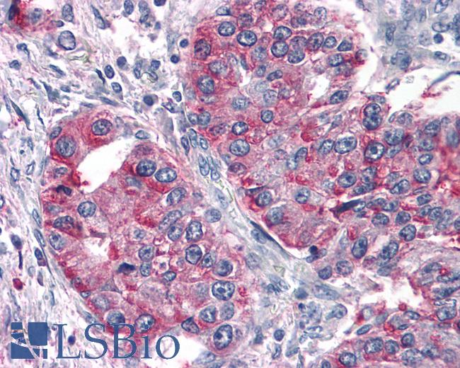 Anti-T1R3 / TAS1R3 antibody IHC of human Lung, Non-Small Cell Carcinoma. Immunohistochemistry of formalin-fixed, paraffin-embedded tissue after heat-induced antigen retrieval.