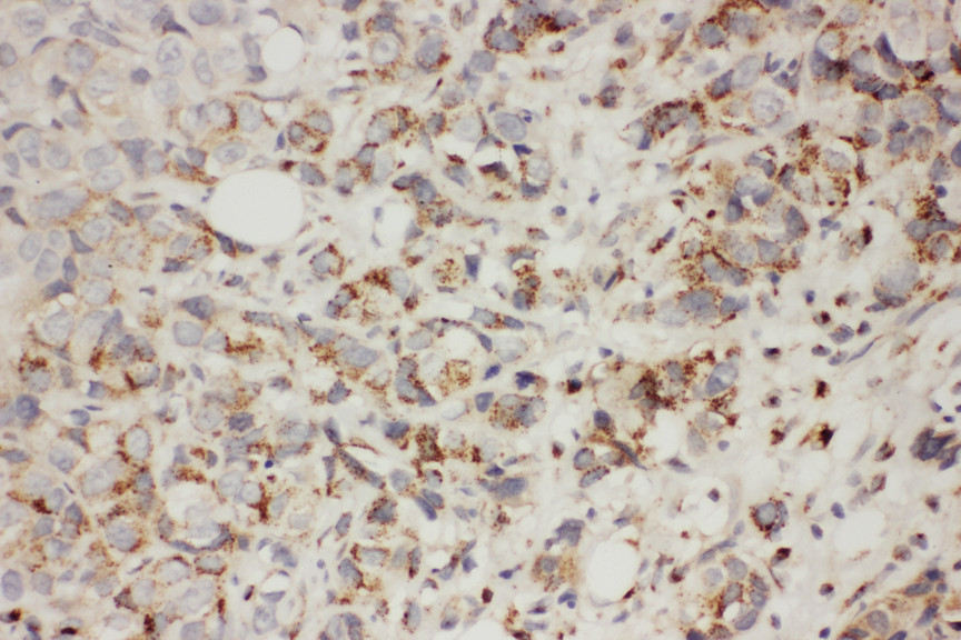 TAB2 antibody. IHC(P): Human Breast Cancer Tissue.