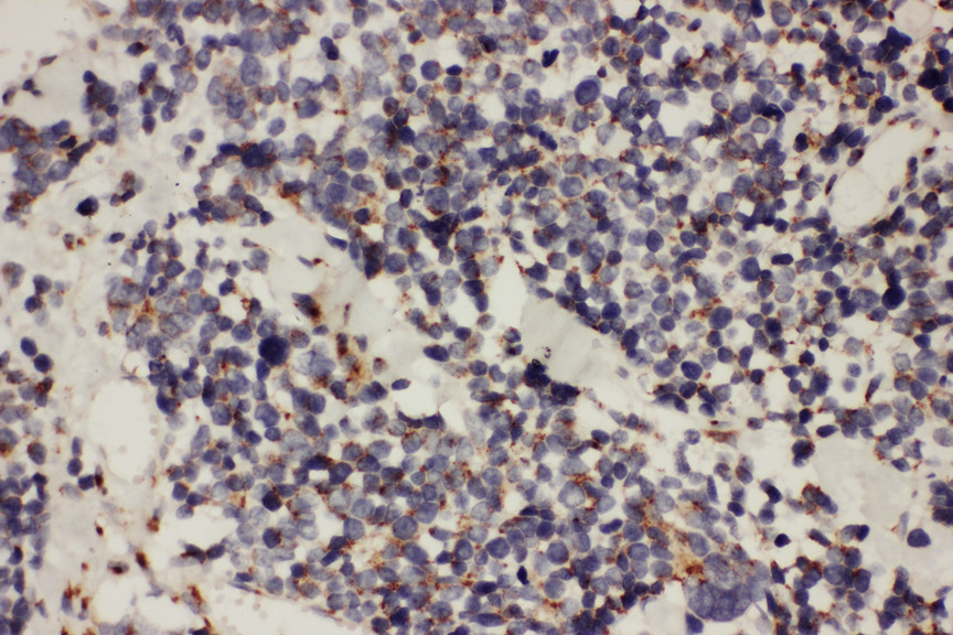 TAB2 antibody. IHC(P): Human Lung Cancer Tissue.