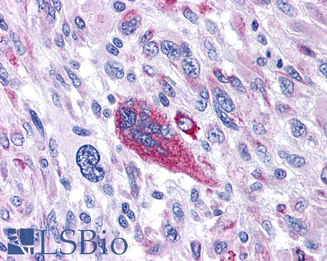 Anti-TACR1 / NK1R antibody IHC of human Brain, Glioblastoma. Immunohistochemistry of formalin-fixed, paraffin-embedded tissue after heat-induced antigen retrieval.