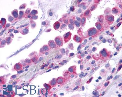 Anti-TACR1 / NK1R antibody IHC of human Lung, Adenocarcinoma. Immunohistochemistry of formalin-fixed, paraffin-embedded tissue after heat-induced antigen retrieval.