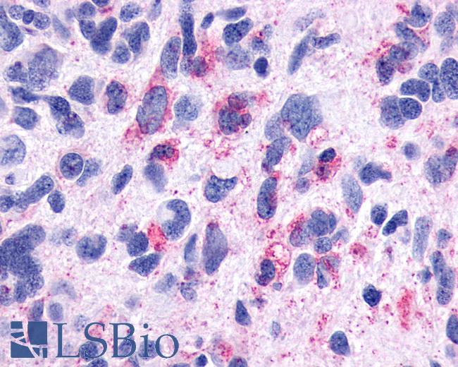Anti-TACR3 / NK3R antibody IHC of human Brain, Glioblastoma. Immunohistochemistry of formalin-fixed, paraffin-embedded tissue after heat-induced antigen retrieval.