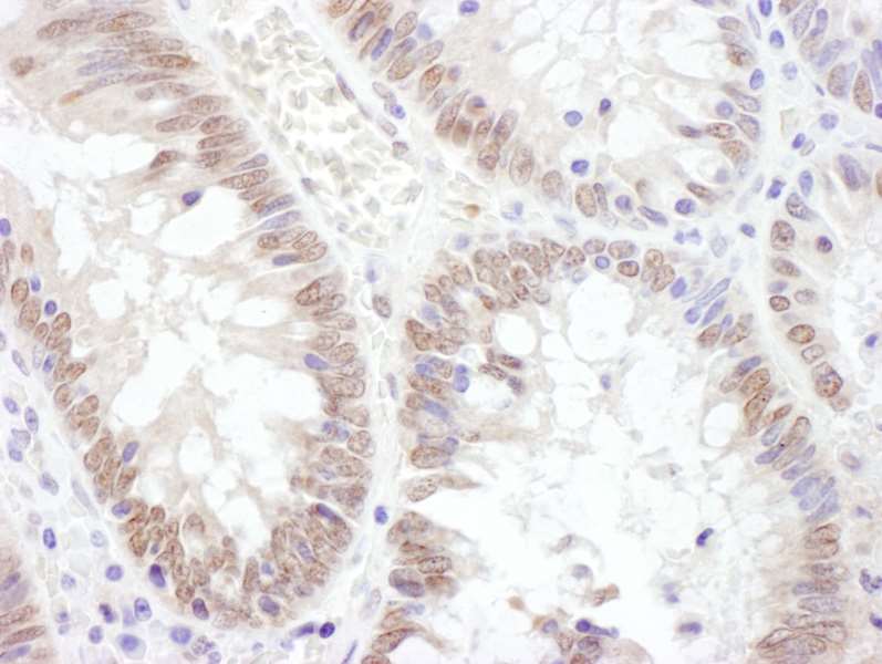 Detection of Human TAF1 by Immunohistochemistry. Sample: FFPE section of human colon carcinoma. Antibody: Affinity purified rabbit anti-TAF1 used at a dilution of 1:1000 (1 ug/ml). Detection: DAB.