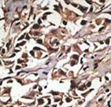 Formalin-fixed and paraffin-embedded human cancer tissue reacted with the primary antibody, which was peroxidase-conjugated to the secondary antibody, followed by DAB staining. This data demonstrates the use of this antibody for immunohistochemistry; clinical relevance has not been evaluated. BC = breast carcinoma; HC = hepatocarcinoma.