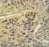 TAF2 Antibody immunohistochemistry of formalin-fixed and paraffin-embedded human lung carcinoma followed by peroxidase-conjugated secondary antibody and DAB staining.