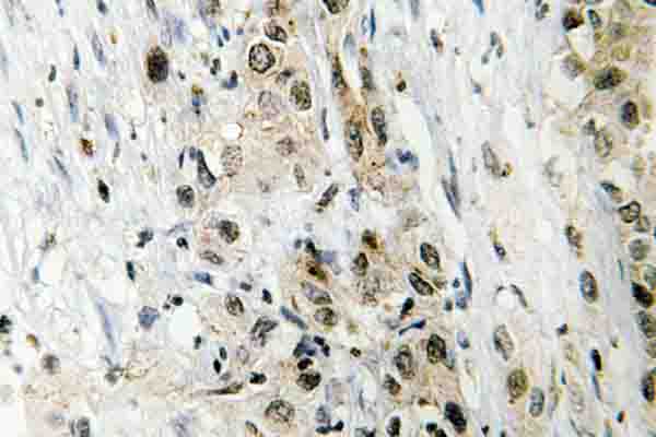 Immunohistochemistry (IHC) analysis of TAF II p100 (G411) pAb in paraffin-embedded human liver cancer tissue.