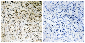 IHC of paraffin-embedded human liver carcinoma tissue, using TAF5 Antibody. The picture on the right is treated with the synthesized peptide.