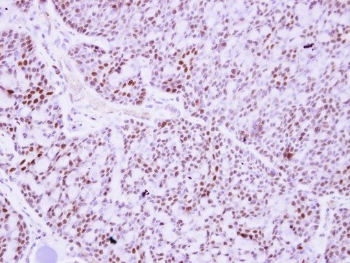 IHC of paraffin-embedded Breast ca, using PTTG2 antibody at 1:250 dilution.
