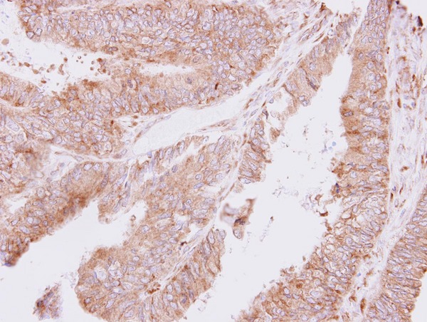 IHC of paraffin-embedded Colon ca, using ThrRS antibody at 1:500 dilution.