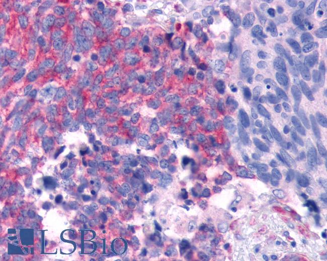 Anti-TAS1R2 / T1R2 antibody IHC of human Lung, Small Cell Carcinoma. Immunohistochemistry of formalin-fixed, paraffin-embedded tissue after heat-induced antigen retrieval.