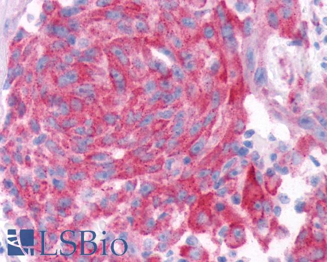 Anti-TAS1R2 / T1R2 antibody IHC of human Skin, Melanoma. Immunohistochemistry of formalin-fixed, paraffin-embedded tissue after heat-induced antigen retrieval.