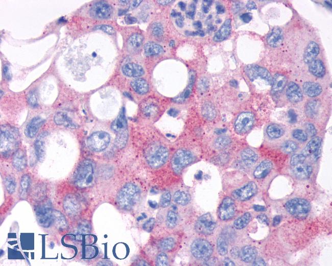 Anti-TAS1R2 / T1R2 antibody IHC of human Colon, Carcinoma. Immunohistochemistry of formalin-fixed, paraffin-embedded tissue after heat-induced antigen retrieval.