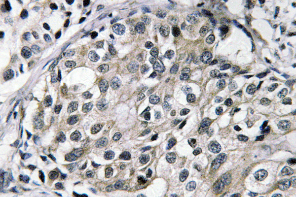 IHC of TAT (E304) pAb in paraffin-embedded human breast carcinoma tissue.