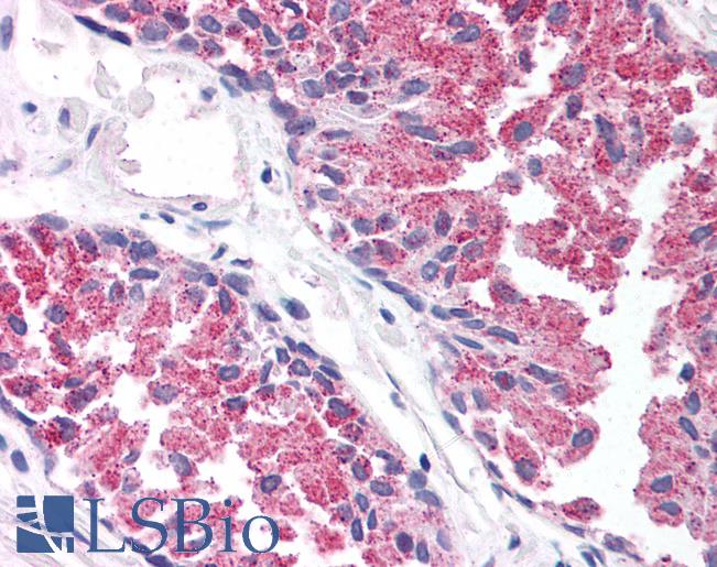 Anti-TBC1D1 antibody IHC of human prostate. Immunohistochemistry of formalin-fixed, paraffin-embedded tissue after heat-induced antigen retrieval. Antibody LS-B1410 concentration 5 ug/ml.